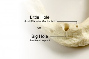 Manhattan MinI Dental Implants comparison to traditional dental implants
